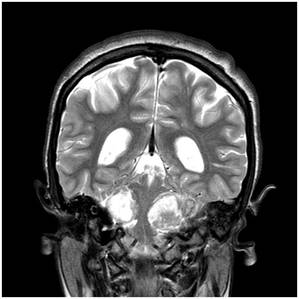 NF 2 coronal T2